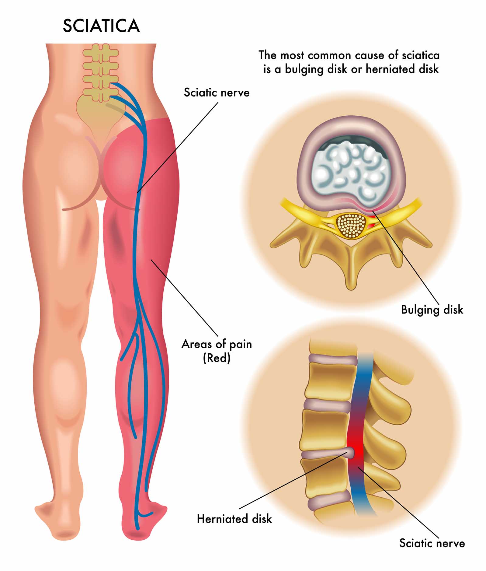 Cranbourne Chiropractor disc bulge treatment